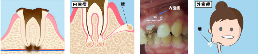 内歯瘻・外歯瘻のイメージ