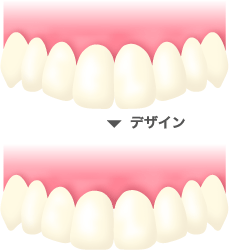 2.仮歯の形をデザインします。