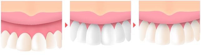 歯冠長延長術
