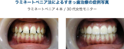 ラミネートべニア法によるすきっ歯治療の症例写真