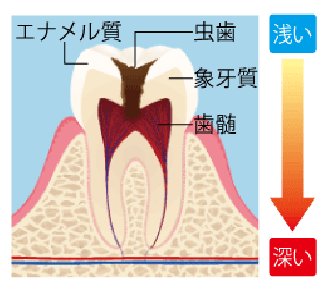 進行度別（C0〜C4）の目安