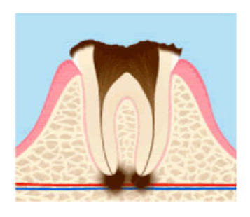 むし歯菌の巣(根尖病巣)