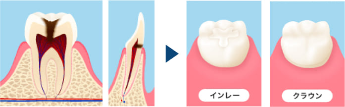 インレー/クラウン