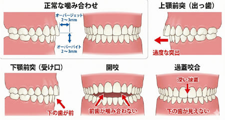 正常な噛み合わせの基準（オーバージェット・オーバーバイト）と、不正咬合（出っ歯、受け口、開咬、過蓋咬合）の比較図
