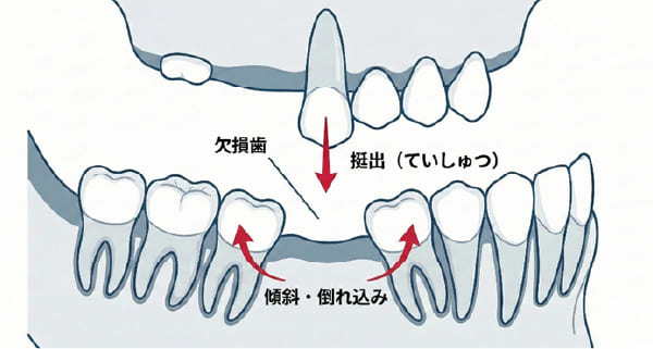歯を失ったまま放置した時に起こる歯の移動（倒れ込み・挺出）の図