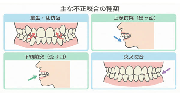 主な不正咬合の種類イラスト（叢生、出っ歯、受け口、交叉咬合など）