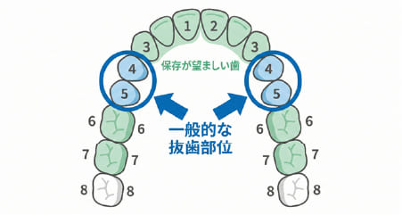 矯正治療で一般的に抜歯対象となる小臼歯（前から4〜5番目）の位置を示す歯列図