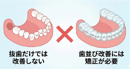 親知らずの抜歯と歯並び改善の誤解（抜歯だけでは歯並びは治らない）を示す図解イラスト