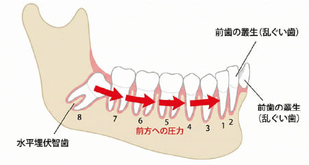 横向きの親知らずが手前の歯を押し、前歯のガタガタ（叢生）の原因になるメカニズムの図解