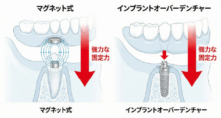 マグネットデンチャーとインプラントオーバーデンチャーの固定の仕組み（安定性の向上）の図解