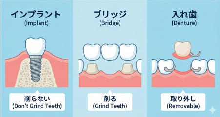 歯を失った時の3つの治療法（インプラント、ブリッジ、入れ歯）の構造と特徴の比較図