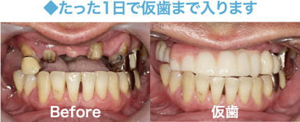 オールオン4治療の症例