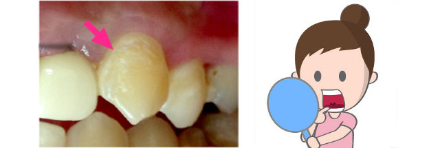 歯の表面の発見法