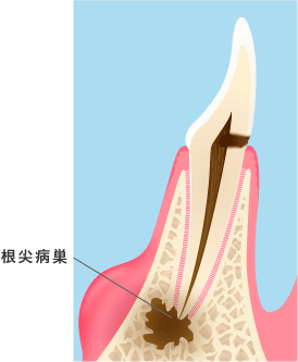 虫歯で歯茎が腫れるのはなぜか？腫れたらどうすればよいのでしょうか 