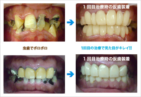 ボロボロの虫歯でも短期間 少回数で治療ok ザ ホワイトデンタルクリニック