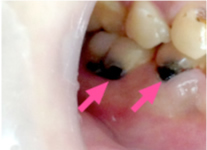 放置した虫歯の治療方法について ザ ホワイトデンタルクリニック