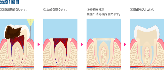 治療1回目