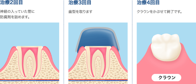 治療2～4回目