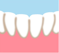 前歯でなりやすい部分のイメージ