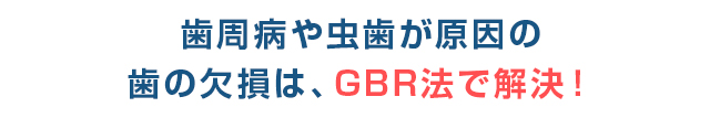 歯周病や虫歯が原因の歯の欠損はGBR法で解決