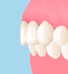 セラミック法による出っ歯の治療法