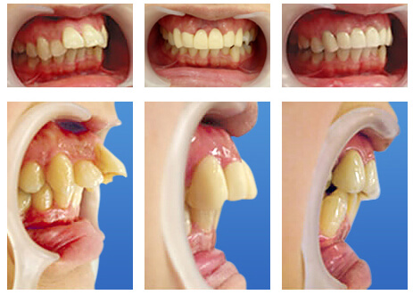 歯科整形で治療する出っ歯矯正 整形 とは ザ ホワイトデンタルクリニック