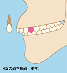 骨格的な出っ歯の治療法