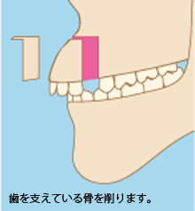 骨格的な出っ歯の治療法