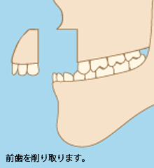 骨格的な出っ歯の治療法