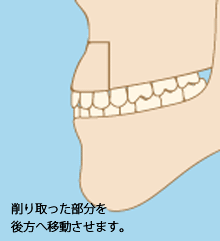 骨格的な出っ歯の治療法