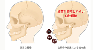 出っ歯で口を閉じづらいのですが