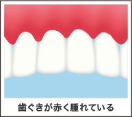 歯茎からの出血 ザ ホワイトデンタルクリニック