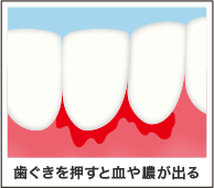 歯茎からの出血 ザ ホワイトデンタルクリニック