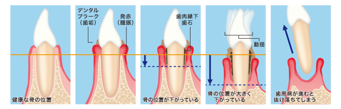 歯周病と歯槽膿漏の違いについて ザ ホワイトデンタルクリニック