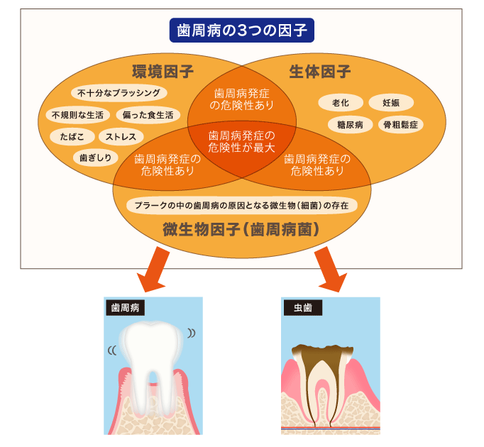 歯周病の3つの因子