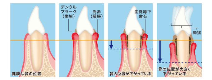 歯周ポケットの深さ