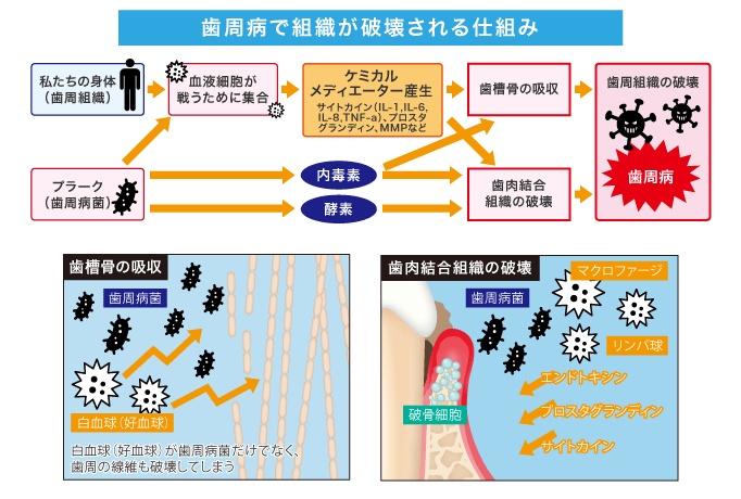 歯周病で組織が破壊される仕組み