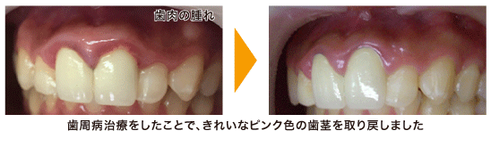 歯周病初期 ザ ホワイトデンタルクリニック