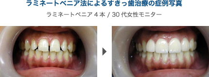 ラミネートべニアによる症例写真