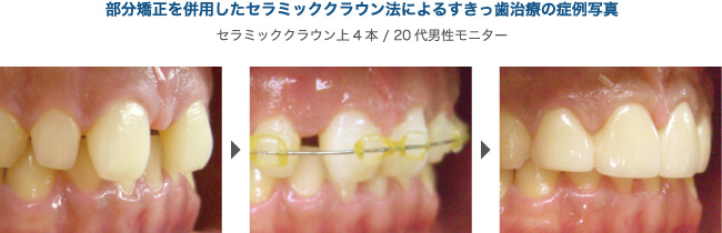 セラミッククラウン法による症例写真