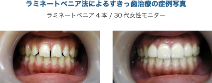 すきっ歯になる原因 少回数で治療できるすきっ歯治療法 ザ ホワイトデンタルクリニック