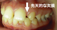 先天的な欠損