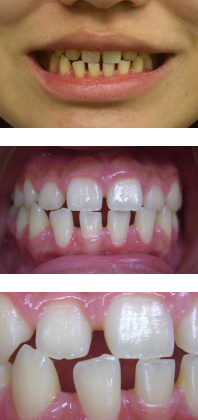 すきっ歯になる原因 少回数で治療できるすきっ歯治療法 ザ ホワイトデンタルクリニック