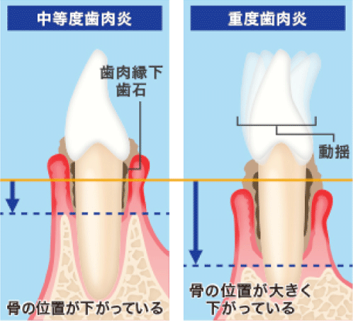 歯周病1